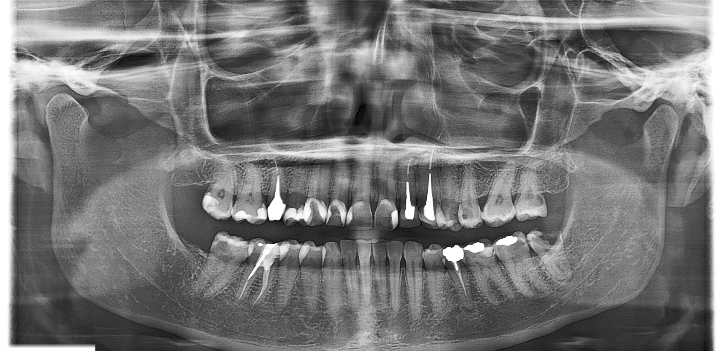 Radio panoramique dentaire avant analyse DentiVision